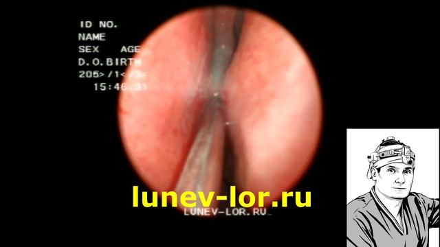 Рассечение синехии полости носа лазером смотреть онлайн
