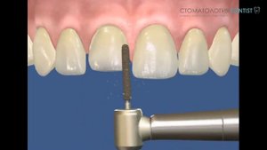 Установка винира на передний верхний зуб. Cтоматология.dentist