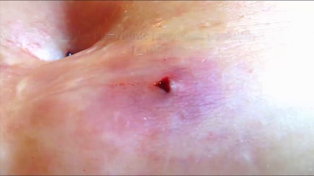 КАК ВЫГЛЯДЯТ УКУСЫ ПИЯВКИ ПОСТПРИСТАВОЧНАЯ РЕАКЦИЯ ПОСЛЕ УКУСА ПИЯВКИ СПРЕЙ ПИЯВИТ