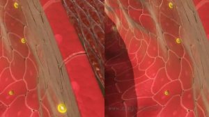 Атеросклероз (сердечно-сосудистое заболевание) 3D SBS