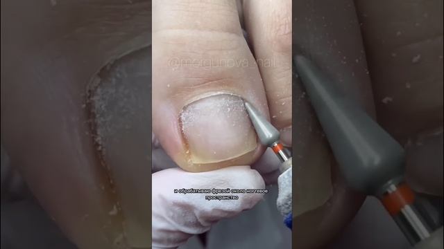 Делаем педикюр и устанавливаем тампонаду .