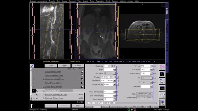 Magnetic resonance angiography legs (MRA lower limbs) positioning, protocols and planning