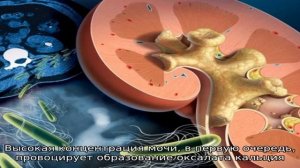 От чего образуются камни в почках