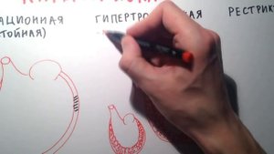 Кардиомиопатии - общая характеристика