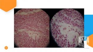 ACTINOMICETOMA POR NOCARDIA BRASILIENSIS: DEL LABORATORIO A LA CLINICA - Dr. Mario César Salinas C.