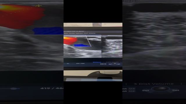 Варикоз. Как лечить варикоз. Лечение варикоза. Флеболог Москва. Флеболог. Сосудистый хирург смотреть онлайн