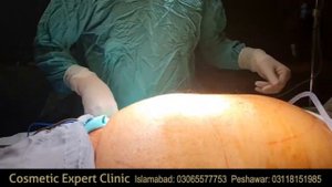 #liposuction #liposuctionsurgery Liposuction (surgery)