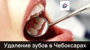 Удаление зубов в Чебоксарах