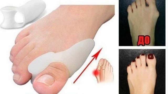 Фиксатор Valgus Pro оригинал, Вальгус Про Корректор большого пальца, косточка на ноге