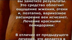 Я страдала от варикоза, пока не узнала об этом натуральном средстве