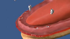 условно съемный протез на 4 импл. с фиксацией на винтах