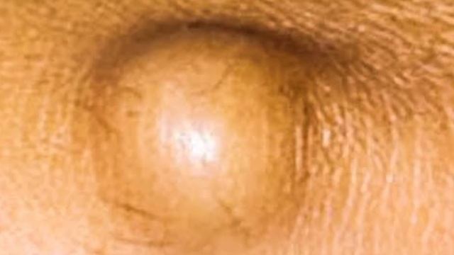 Как избавится от Жировика (липомы) с помощью яйца... Самый эффективный народный метод смотреть онлайн