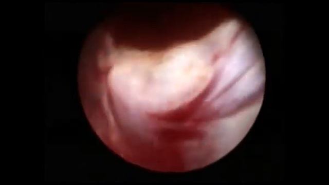 Субмукозная миома. Резекция миомы