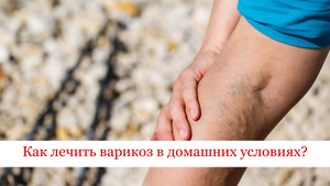Как лечить варикоз ног в домашних условиях?