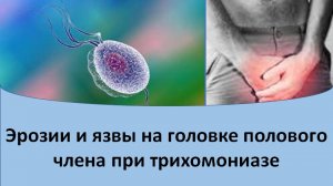 Эрозии и язвы на головке полового члена при трихомониазе