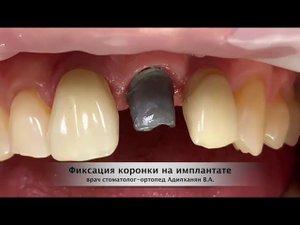 Фиксация коронки на импланте. Работа доктора хирурга-стоматолога Адилханян В.А.