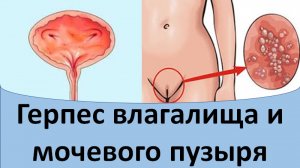 Герпес  влагалища и мочевого пузыря