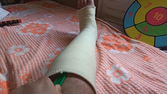 Лайфхак с гипсом! Как почесать сломанную ногу в гипсе?