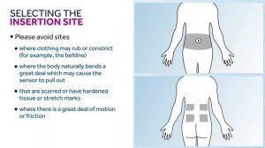 Medtronic Guardian Connect - как установить сенсор