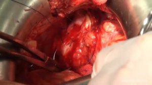 Кольпосуспензия по Берчу в лечении стрессового недержания мочи у женщин