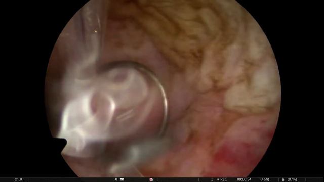 საშვილოსნოს სუბმუკოზური მიომა#submucosus mioma#субмукозная миома матки