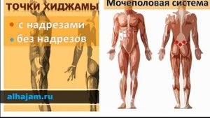 Точки Хиджамы от простатита