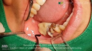 Ezi-Crown создание одиночной коронки.mp4