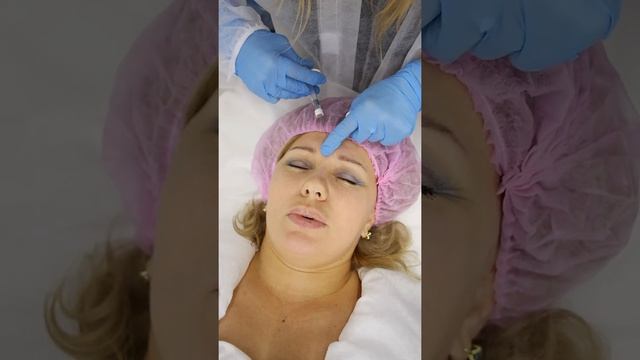 Коррекция межбровья филлером FEEL DERLI NORMAL