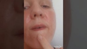 Пилинг Джеснера BTpeel