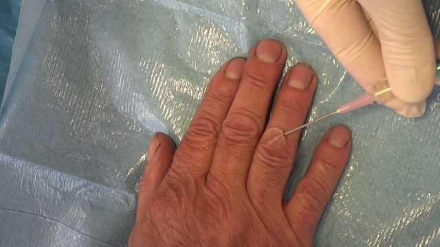 VÄIKEKIRURGIA PEREARSTILE. SÕRME LIMATSÜSTI PUNKTSIOON смотреть онлайн