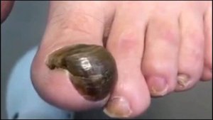 Онихогрифоз ??? • Наступила корова??