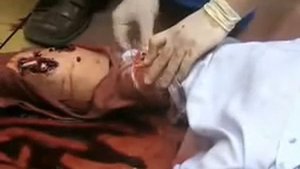 остановка кровотечения наложением жгута закрутки