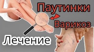 Паутинки и звёздочки ног, тела - причины и ЛЕЧЕНИЕ Телеангиоэктазии склеротерапия