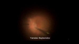 Пересадка сеткатки (аутологичная) при рефрактерном макулярном разрыве