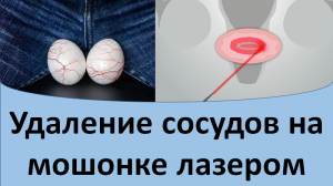 Удаление сосудов на мошонке лазером.