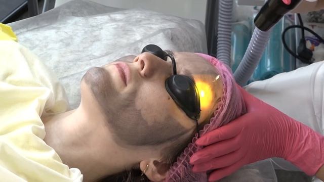 Карбоновый пилинг с помощью лазера "Марина" смотреть онлайн