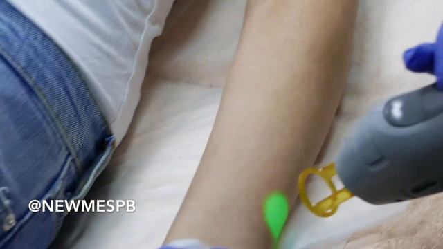 Лазерная эпиляция рук смотреть онлайн