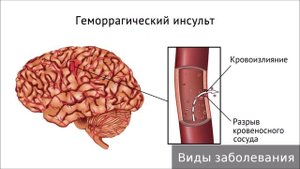 Геморрагический инсульт