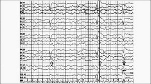 Доброкачественные паттерны на ЭЭГ. Часть 2