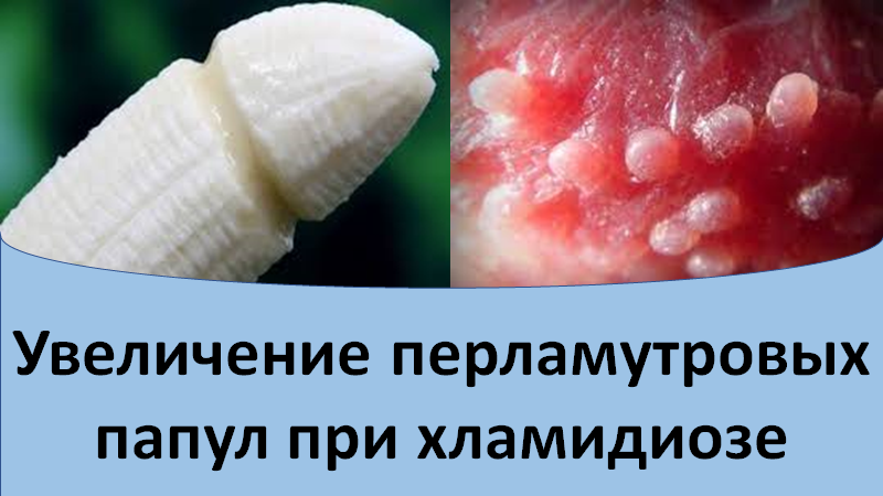 Увеличение перламутровых папул при хламидиозе