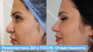 Ринопластика: ДО и ПОСЛЕ. Отзыв пациента. Как прошла операция в ОН КЛИНИК.