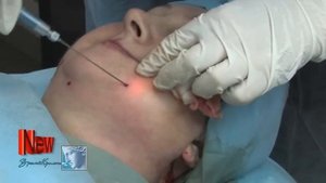 Лазерный липолиз