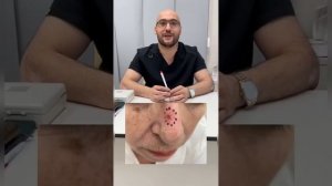 Клинический случай Мурата Тарба. #базалиома