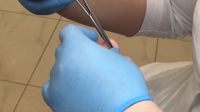 Установка скобы VHO. Коррекция вросшего ногтя. смотреть онлайн