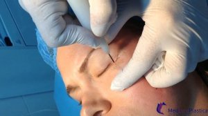 Холодная плазма   родиочастотная шлифовка морщин области глаза