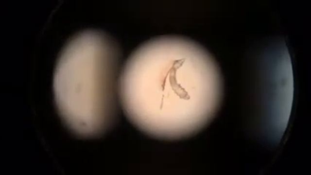 Живой демодекоз. Live demodecosys. смотреть онлайн