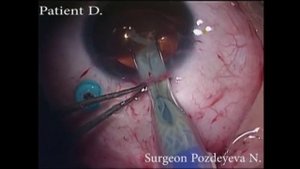Имплантация искусственной иридохрусталиковой диафрагмы_Artificial iris-lens diaphragm implantation.
