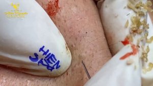 Satisfying video with Hien Nguyen Spa Beauty #015