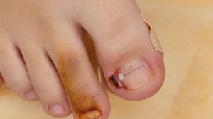 Демонстрация установки коррекционной системы Титановая нить при врастании ногтей