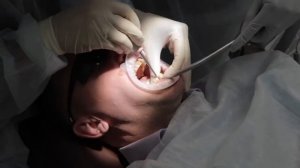 Отзыв пациента после имплантации методом "Все на 4" Наша стоматология СПб